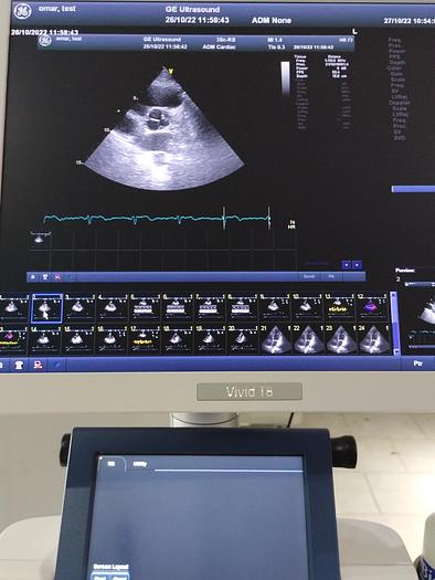 Gebraucht GE Vivid T8 Ultraschallsystem für Herz- und Gefäß-Ultraschall mit Kardio Sonde SW: R1.0.7