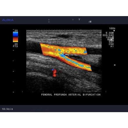 ECHOGRAPHE NUMERIQUE ALOKA PROSOUND 5500 COULEUR DOPPLER