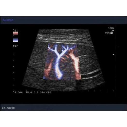 ECHOGRAPHE NUMERIQUE ALOKA PROSOUND 5500 COULEUR DOPPLER
