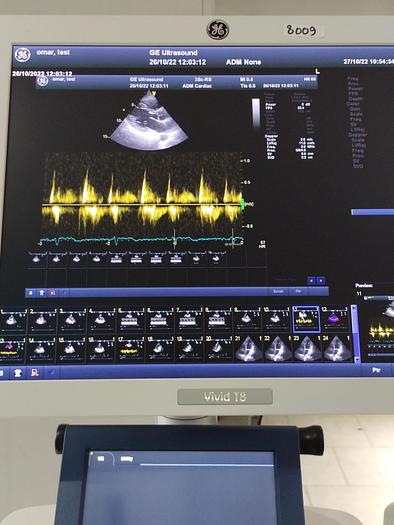 Gebraucht GE Vivid T8 Ultraschallsystem für Herz- und Gefäß-Ultraschall mit Kardio Sonde SW: R1.0.7