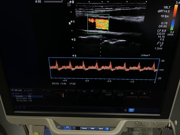 Used Ultraschallgerät Aplio 400 mit 3x Sonden und Printer