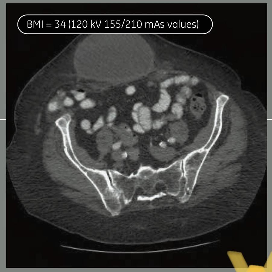 Reformado Tomografo General Electric Optima 660 de 64 cortes
