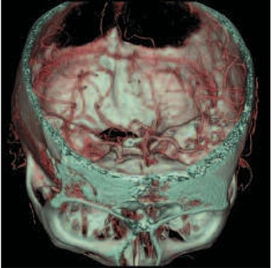 Refurbished General Electric (GE) LightSpeed VCT