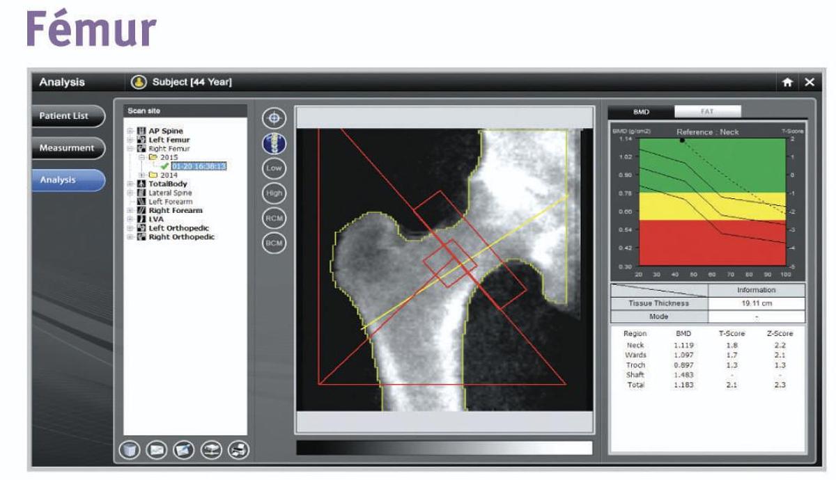Densitómetro Óseo OsteoSys PRIMUS DXA de Cuerpo Completo
