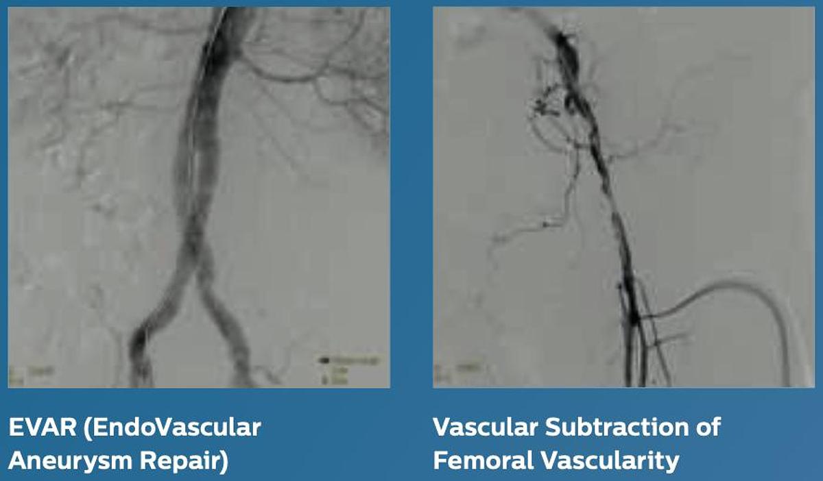 Usado Philips Veradius Unity