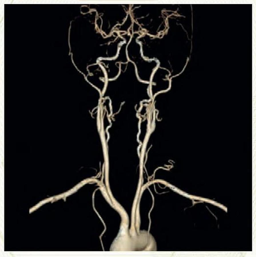 Reformado Tomografo Optima 660 GE (General Electric) 64 cortes