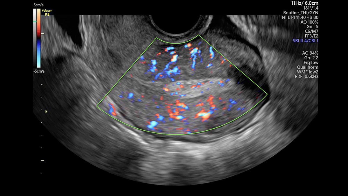 Refurbished Ultrasonido General Electric (GE) Voluson P8 BT22