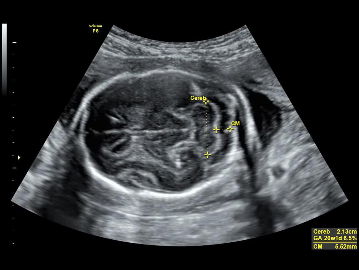 Refurbished Ultrasonido General Electric (GE) Voluson P8 BT22