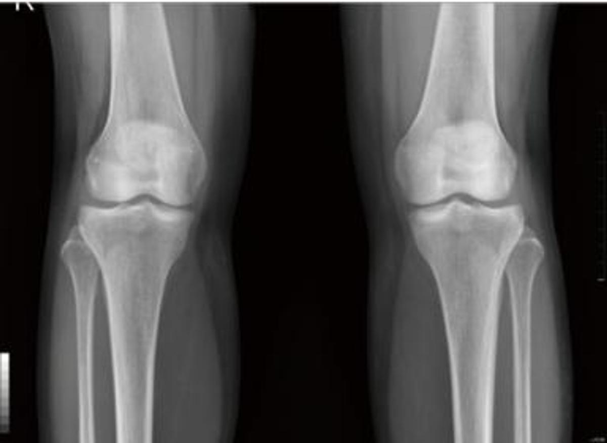 Flat Panel (DR) PIXXGEN PRUDENT 14x17