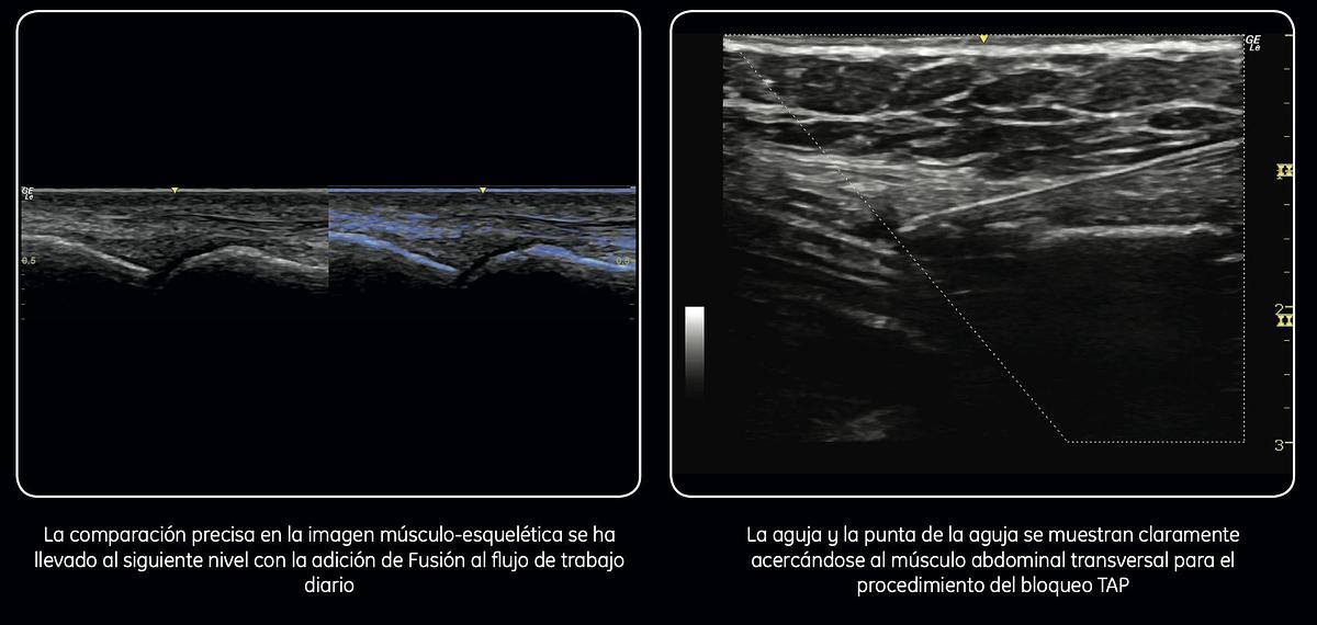 Reformado Ultrasonido portátil General Electric (GE) LOGIQ e