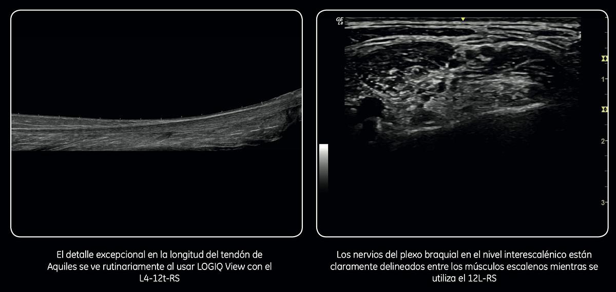 Refurbished Ultrasonido portátil General Electric (GE) LOGIQ e
