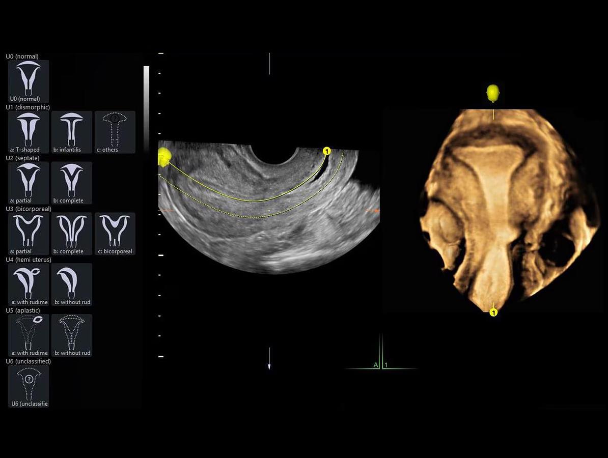 Refurbished Ultrasonido General Electric (GE) Voluson P8 BT22