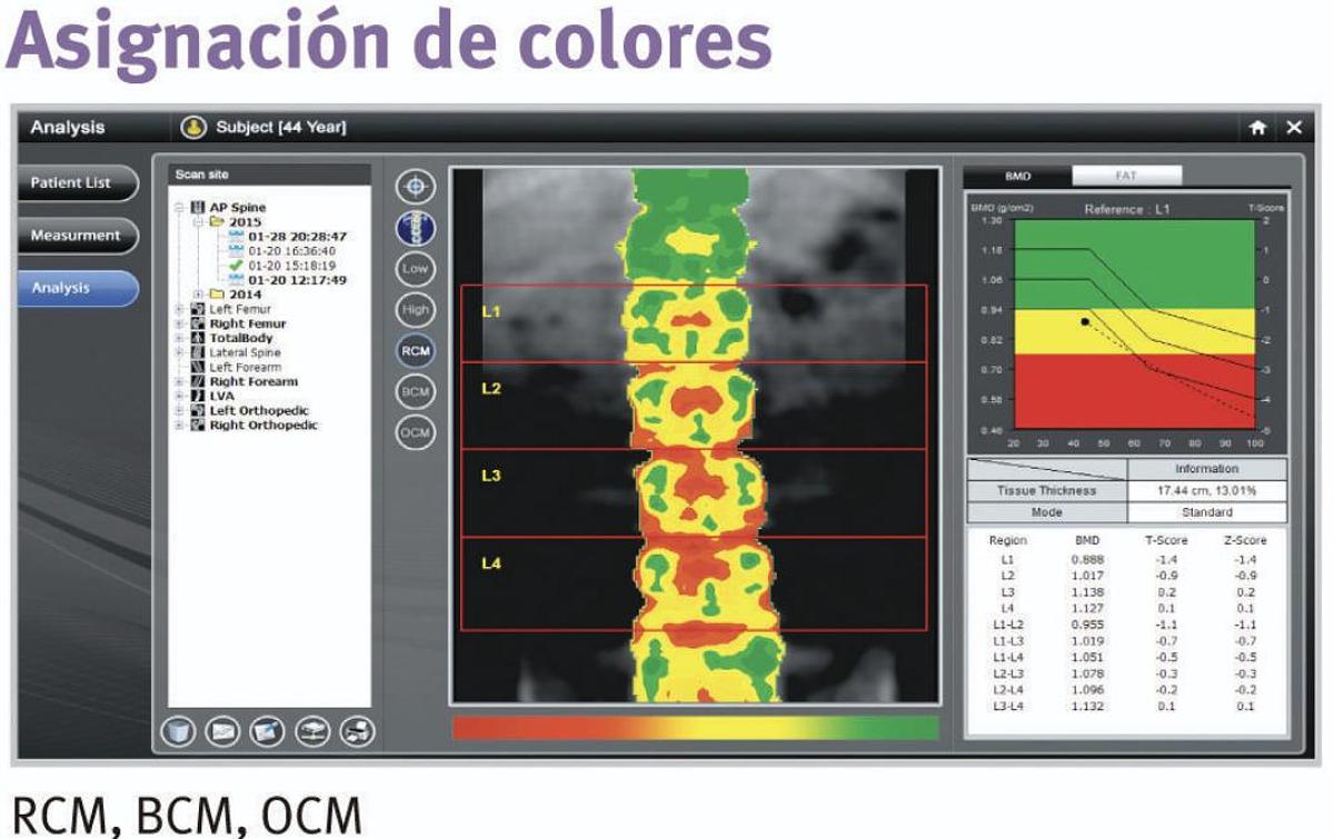 Densitómetro Óseo OsteoSys PRIMUS DXA de Cuerpo Completo
