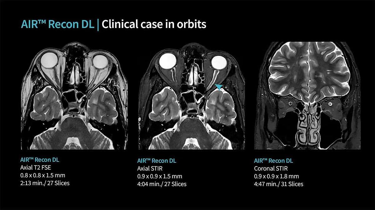 Refurbished 2019 General Electric (GE) Signa Explorer 1.5T