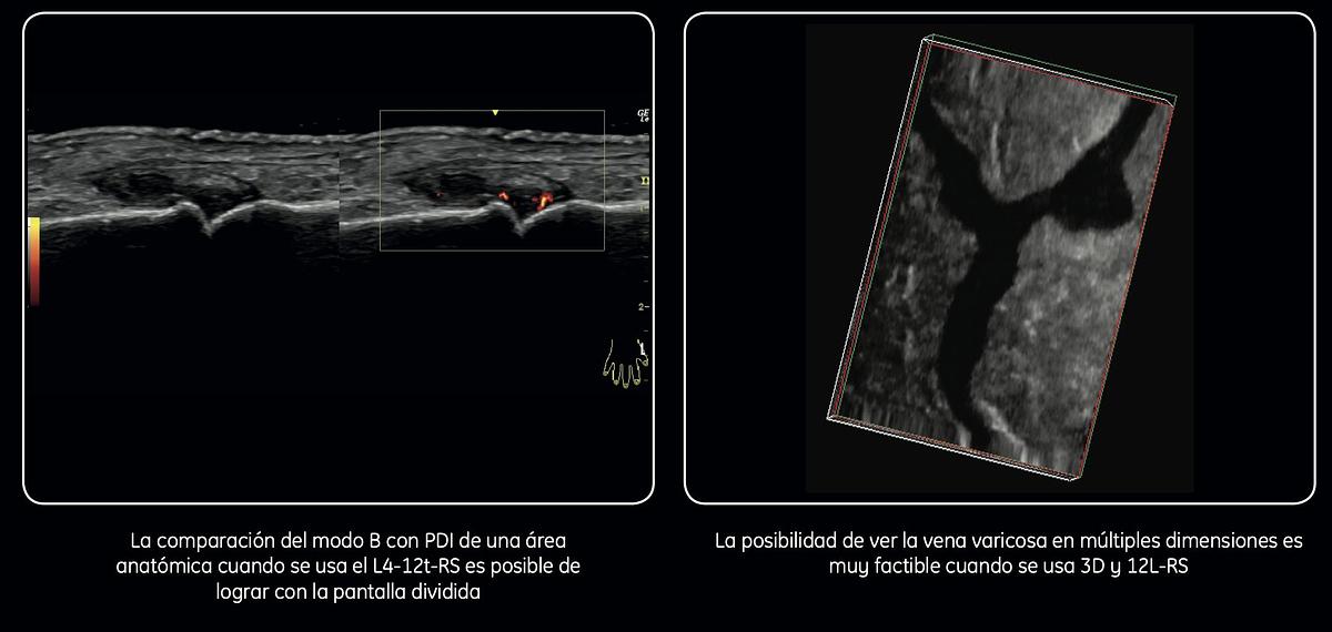 Refurbished Ultrasonido portátil General Electric (GE) LOGIQ e
