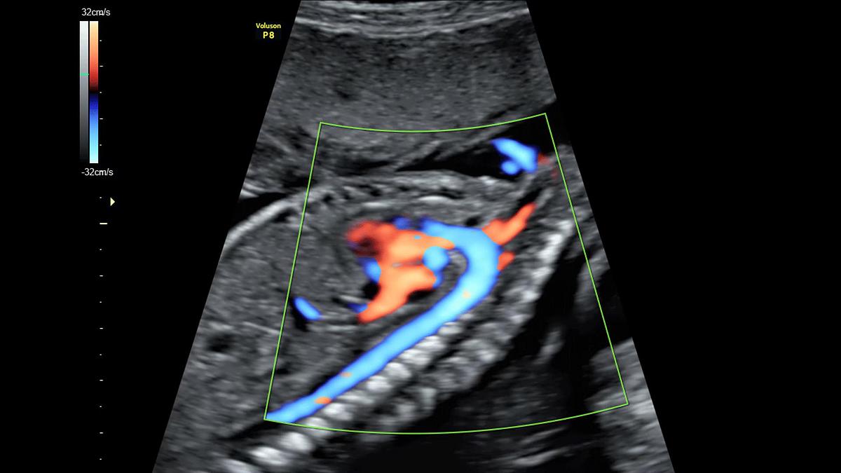 Refurbished Ultrasonido General Electric (GE) Voluson P8 BT22