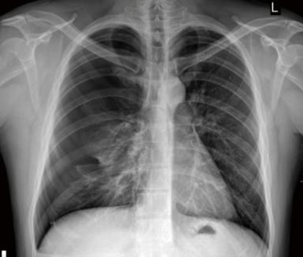 Flat Panel (DR) PIXXGEN PRUDENT 14x17