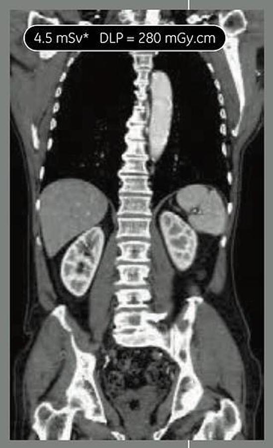 Reformado Tomografo Optima 660 GE (General Electric) 64 cortes