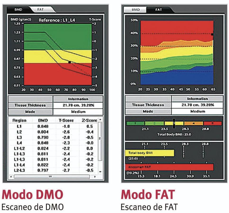 Densitómetro Óseo OsteoSys PRIMUS DXA de Cuerpo Completo