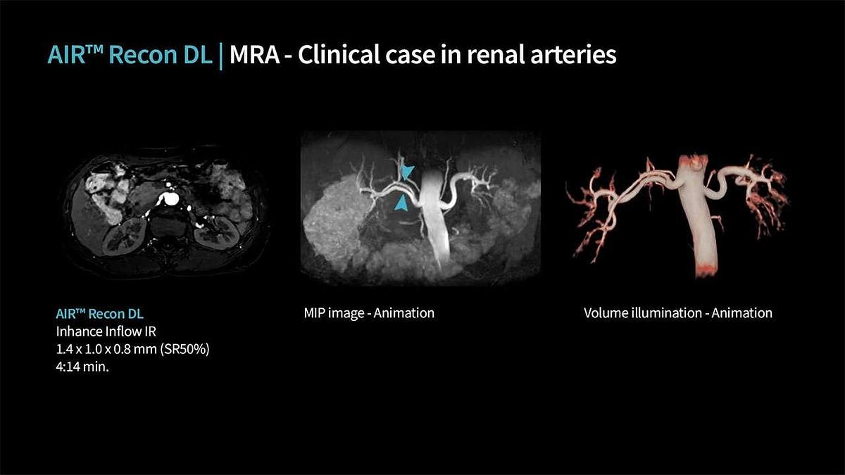 Refurbished 2019 General Electric (GE) Signa Explorer 1.5T