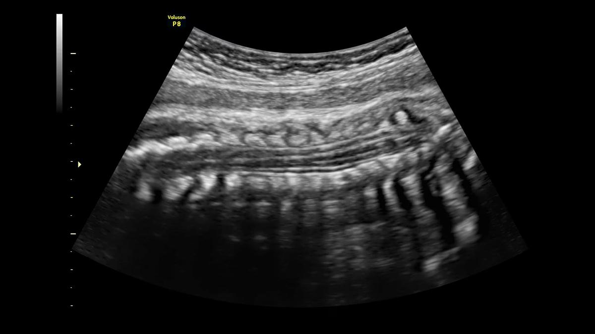 Refurbished Ultrasonido General Electric (GE) Voluson P8 BT22