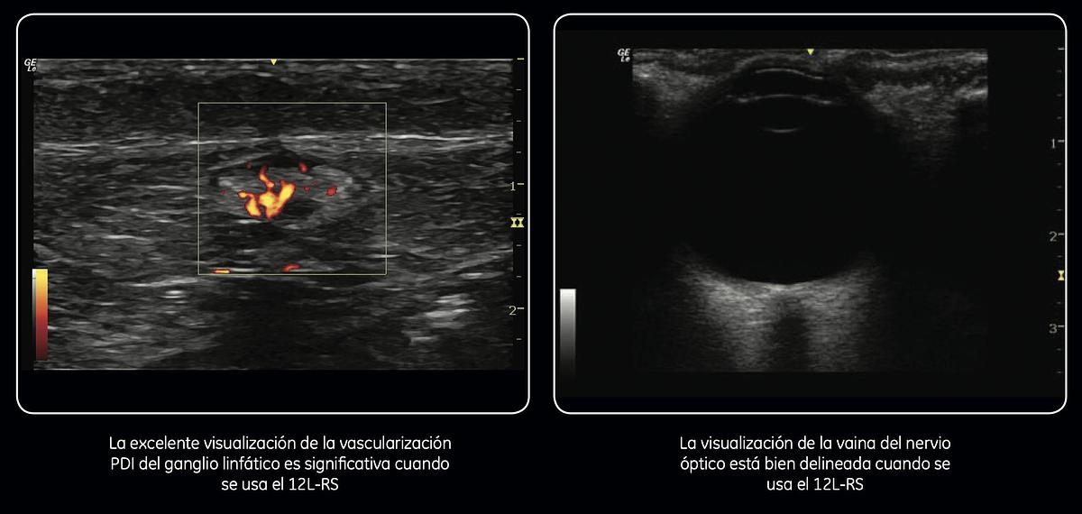 Refurbished Ultrasonido portátil General Electric (GE) LOGIQ e