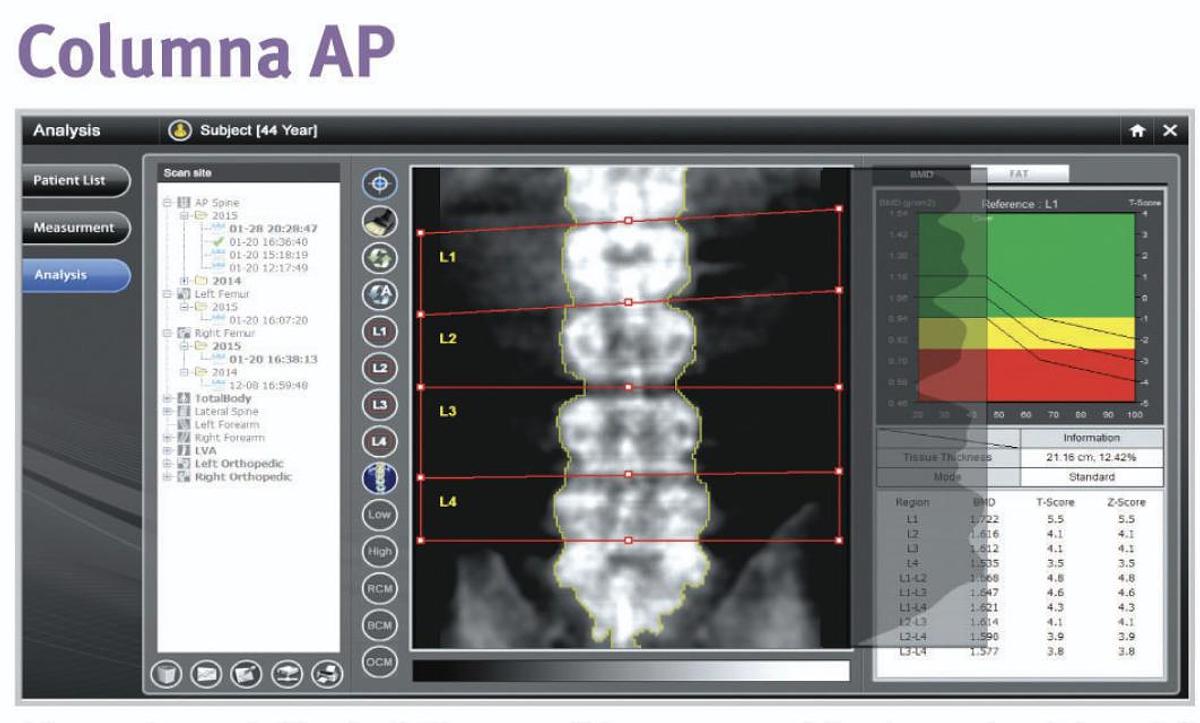 Densitómetro Óseo OsteoSys PRIMUS DXA de Cuerpo Completo
