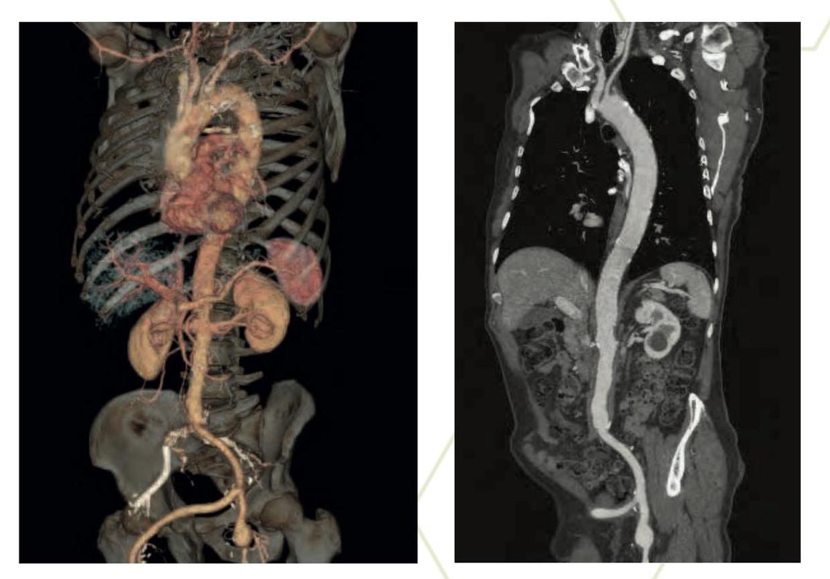 Reformado Tomografo General Electric Optima 660 de 64 cortes