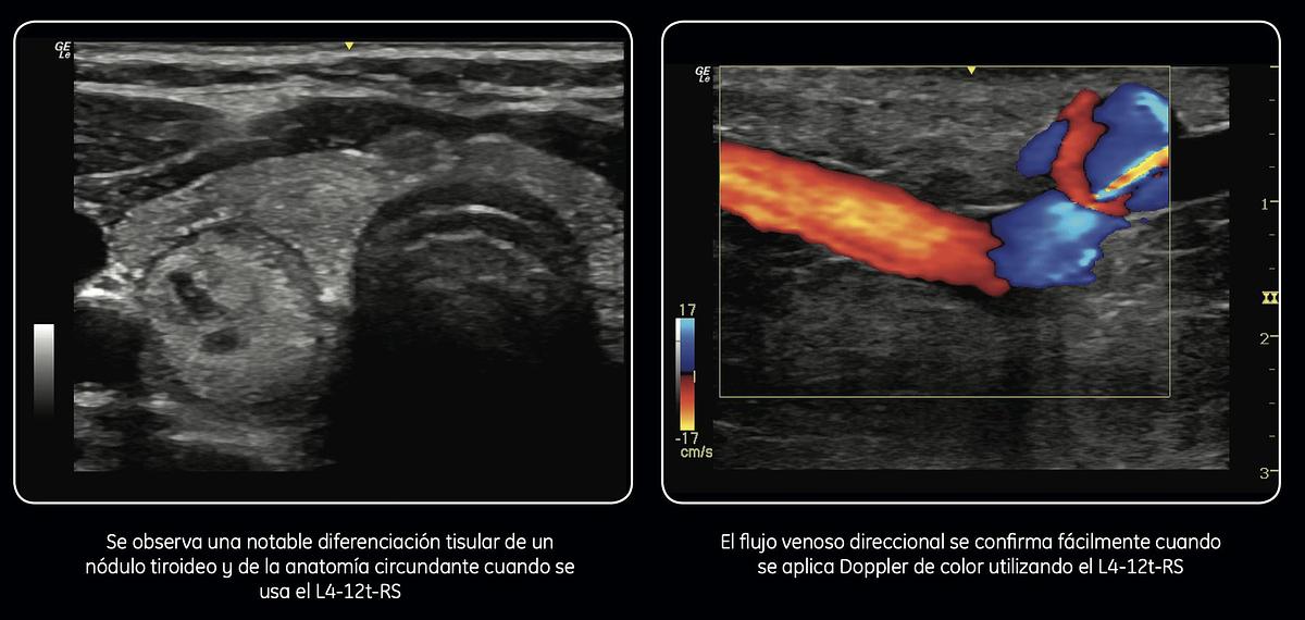 Refurbished Ultrasonido portátil General Electric (GE) LOGIQ e