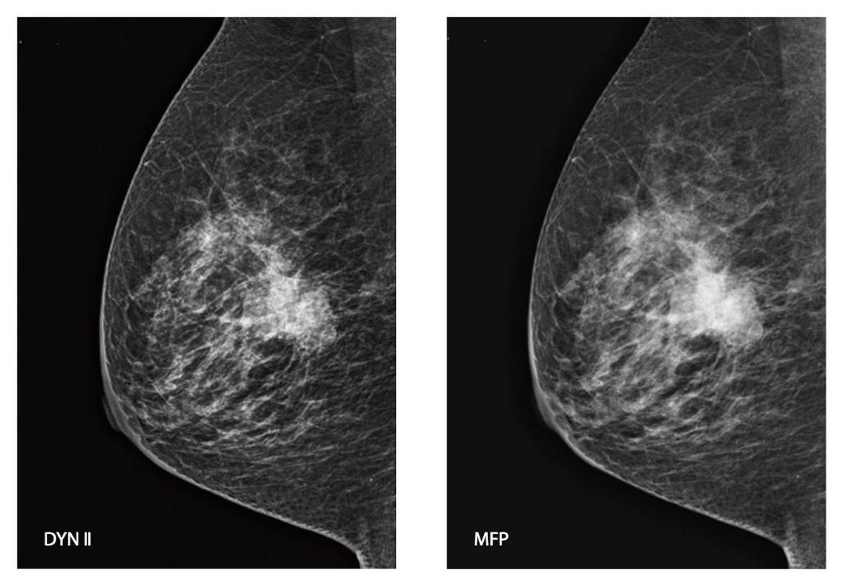 2025 FujiFilm Amulet Innovality Tomosynthesis