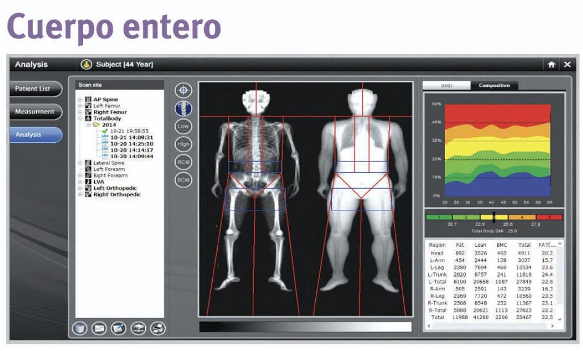 Densitómetro Óseo OsteoSys PRIMUS DXA de Cuerpo Completo