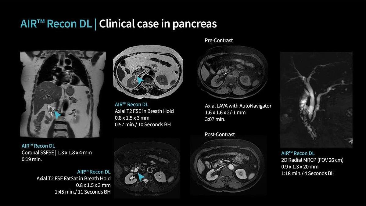 Refurbished 2019 General Electric (GE) Signa Explorer 1.5T