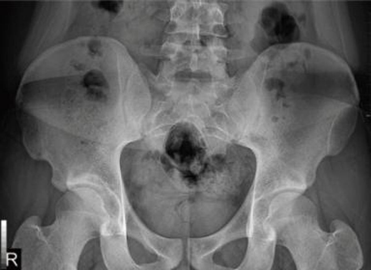 Flat Panel (DR) PIXXGEN PRUDENT 14x17