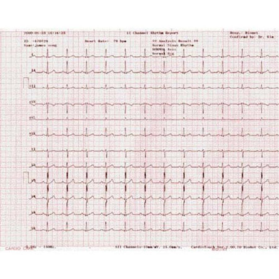 Used Bionet ECG Paper for Cardiocare 2000, 3000