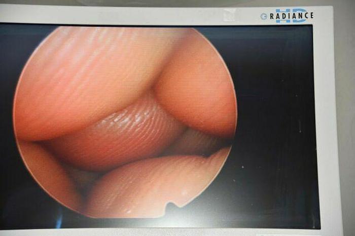 Used RICHARD WOLF 8672.433 Laparoscope