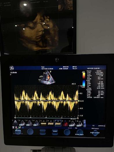 Gebraucht GE Vivid S6 Ultraschallsystem mit Sony Drucker und 1x Sonde
