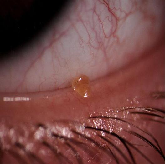 Used NEW S4Optiks Slit Lamp Camera Upgrade