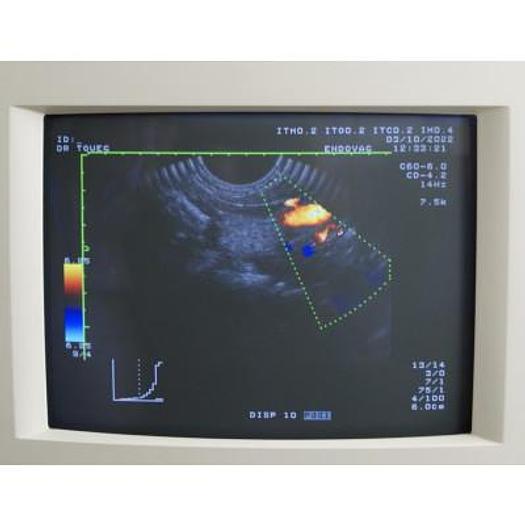 Used ECHOCARDIOGRAPHE TOSHIBA POWERVISION 6000 AVEC 3 SONDES