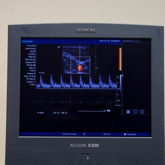 Used SIEMENS X300 FLAT SCREEN COLOR DOPPLER ULTRASOUND SCANNER WITH V13-5 SURFACE PROBE