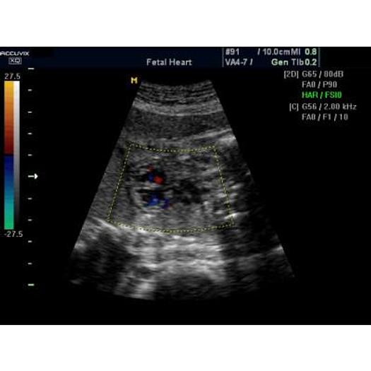 Used 3D/4D COLOR DOPPLER ULTRASOUND SCANNER, SAMSUNG MEDISON ACCUVIX XQ
