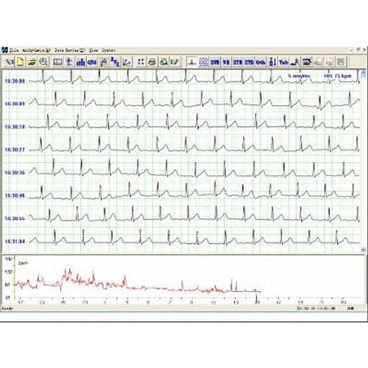 ECG HOLTER