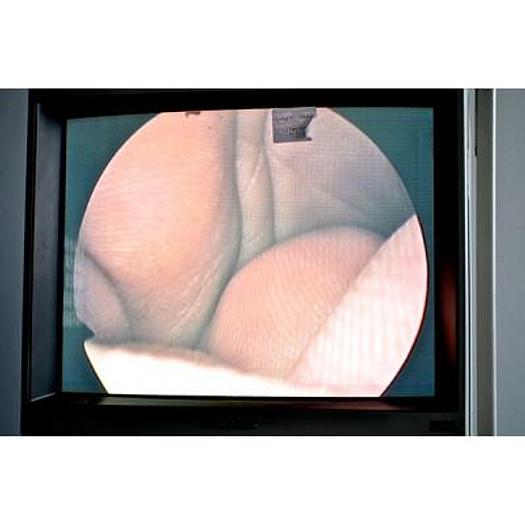 Used ENDOSCOPY COLUMN WITH DOWNS CAMERA AND XENON SOURCE