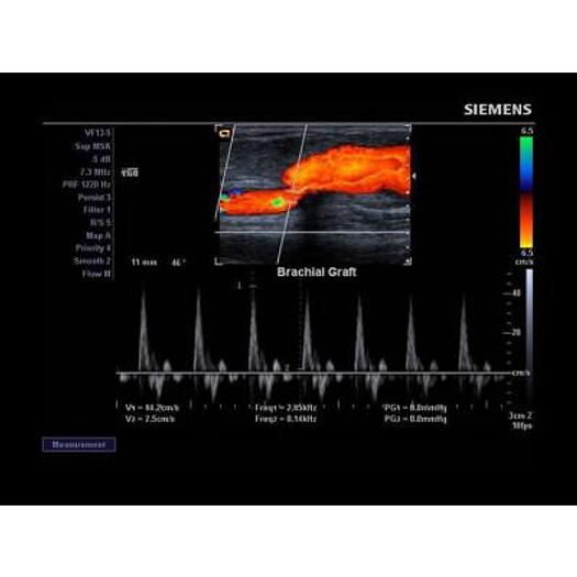 Used ULTRASOUND SIEMENS X150 FLAT SCREEN, COLOR DOPPLER WITH CONVEX ABDOMINAL PROBE 2-5 MHZ AND SUPERFICIAL LINE PROBE 5-10 M