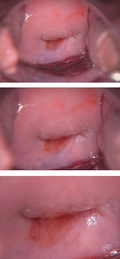 Rénové FAUTEUIL GYNÉCOLOGIQUE SCHMITZ MEDI-MATIC AVEC VIDEO COLPOSCOPE VIDAN INTEGRÉ ET ECRAN