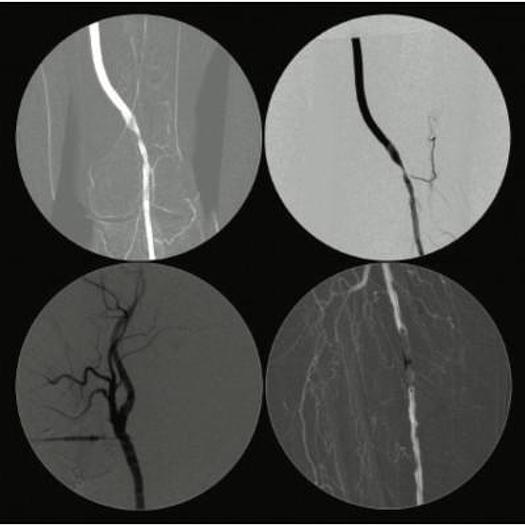 Used BRILLIANCE AMPLIFIER (04/2018) GENERAL ELECTRIC FLUOROSTAR for general and vascular applications