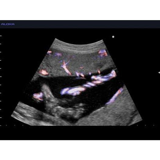 ALOKA PROSOUND 5500 COLOR DOPPLER DIGITAL ULTRASOUND SCANNER