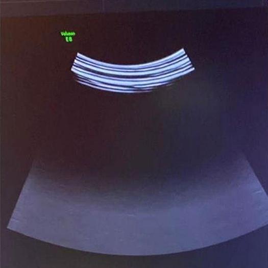 Used GE VOLUSON E8 RSA BT19 ULTRASOUND SCANNER