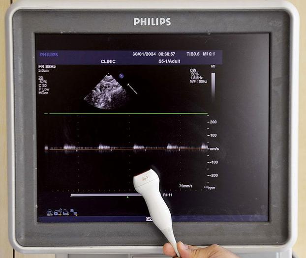 D'occasion ECHOCARDIOGRAPHE PHILIPS IE33 CARDIAQUE