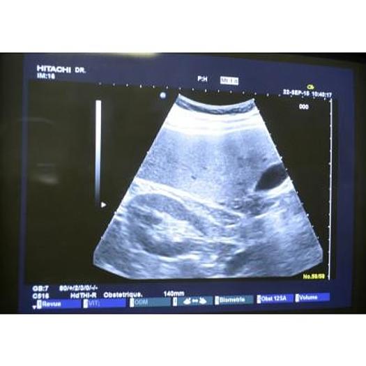 Used HITACHI EUB 6500 PLATFORM ELITE COLOR ULTRASOUND SCANNER WITH 4 PROBES