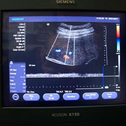 Used SIEMENS ACUSON X150 ULTRASOUND SCANNER WITH 3 PROBES AND FLAT SCREEN